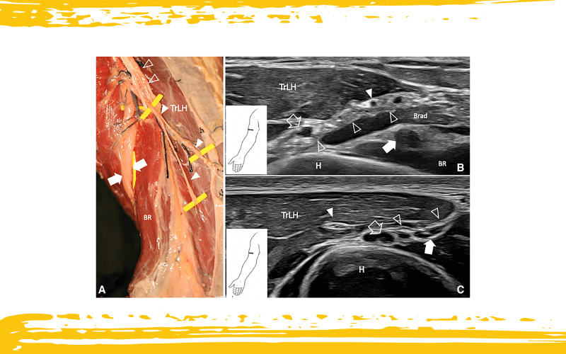 2. Nervio cutaneo posterior antebrazo tempo formacion ecografia.png